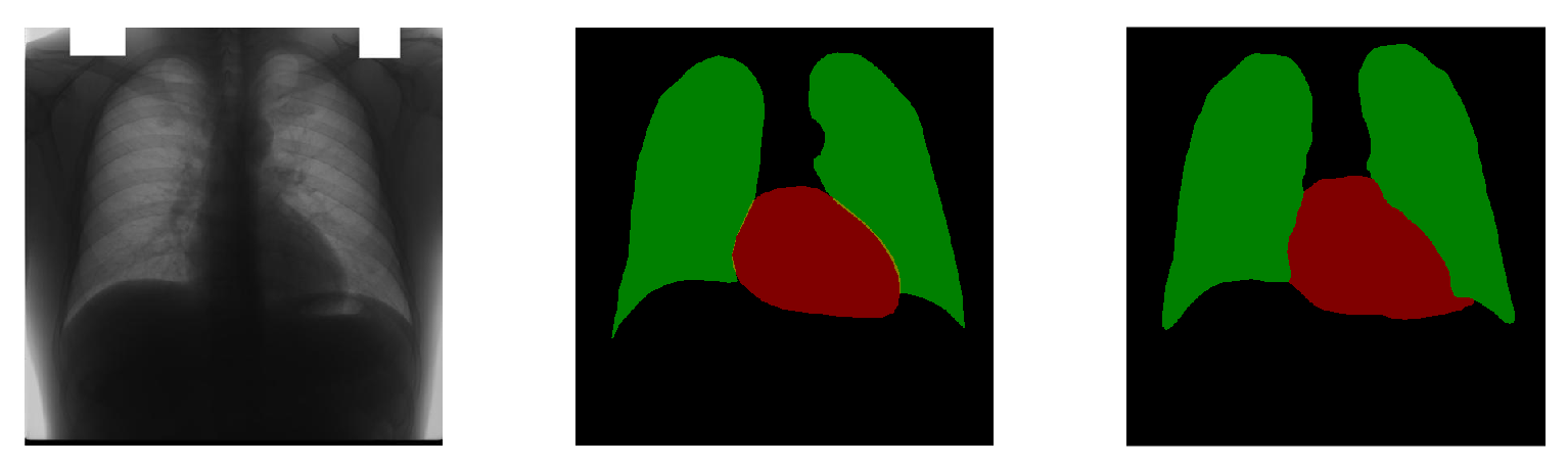 Chest X-ray Segmentation